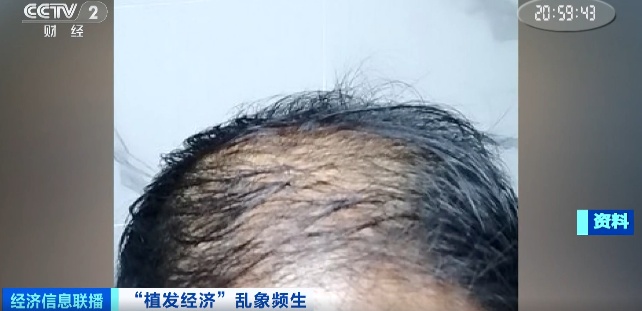 曝光了！“没长出来”“秃的”！有人欠下万元“植发贷”……