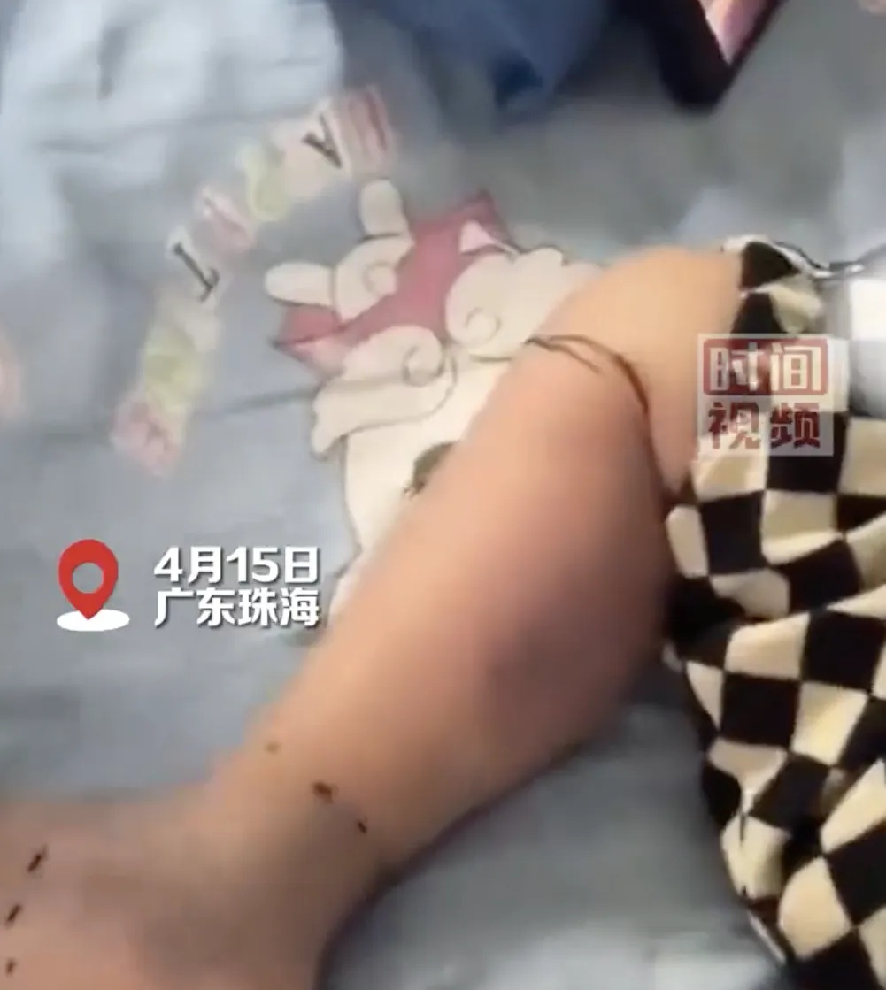 2岁男童住进ICU面临截肢，只因去了趟菜市场？