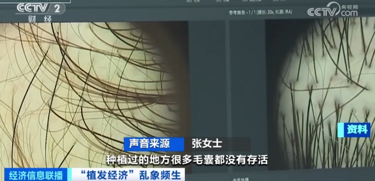 曝光了！“没长出来”“秃的”！有人欠下万元“植发贷”……