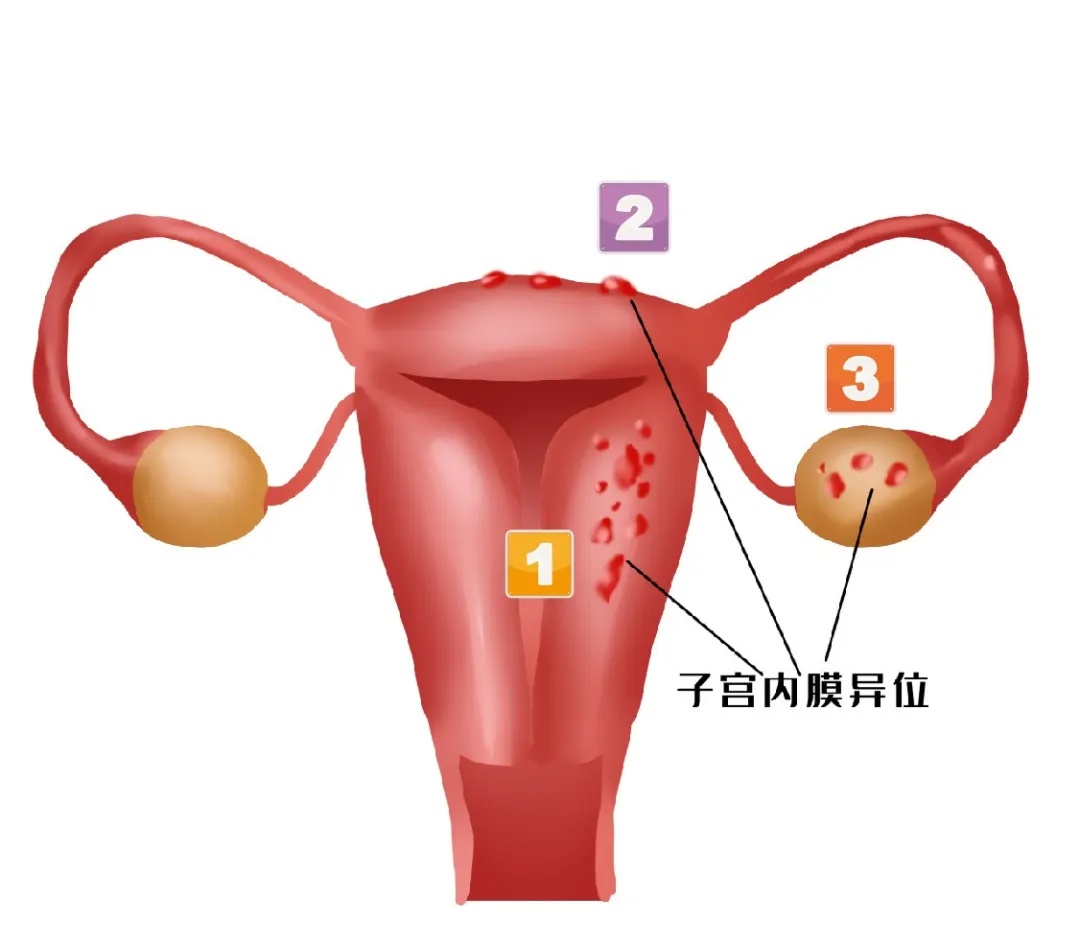 下个月就要结婚，28岁姑娘却将失去子宫…身体出现这些情况，要警惕！