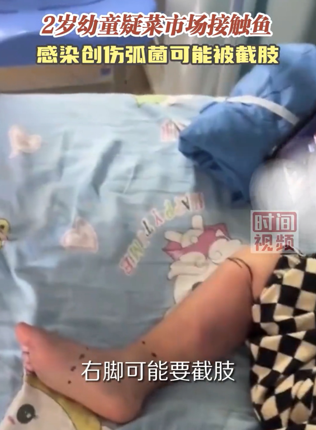 2岁男童摸鱼后面临截肢？千万小心这种“致命”细菌