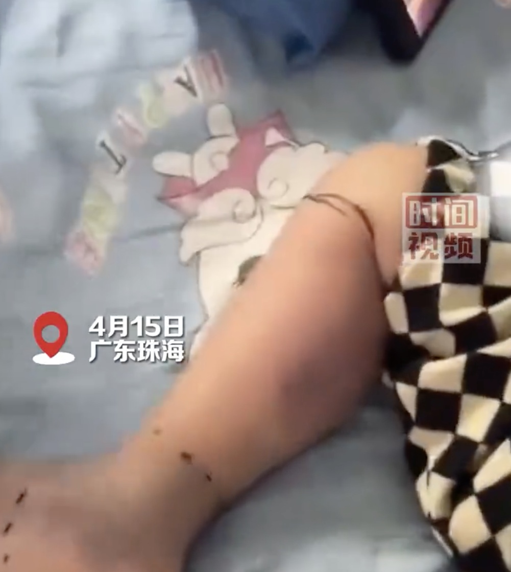 2岁男孩住进ICU面临截肢！只因跟家人去买了条鱼？已有死亡病例！