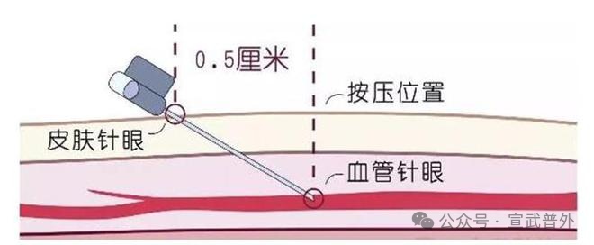 扎针后明明不出血了，为什么会青紫？