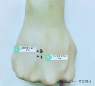 扎针后明明不出血了，为什么会青紫？