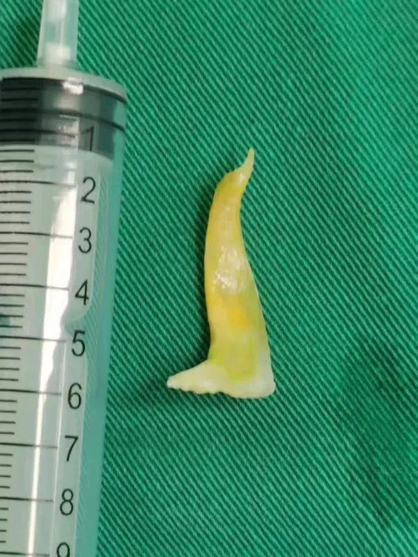 东莞一女子咳嗽3个月,医生从她肺里夹出… 东莞一女子咳嗽3个月,医生从她肺里夹出…