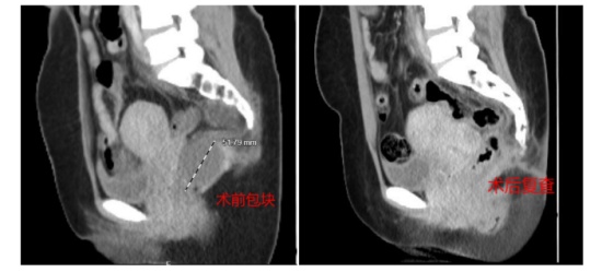 女子下腹隐痛三次求医未果,原是这种罕见病 女子下腹隐痛三次求医未果,原是这种罕见病