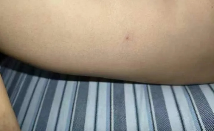 新型布尼亚病毒阳性!医生提醒:已进入高发期 新型布尼亚病毒阳性!医生提醒:已进入高发期