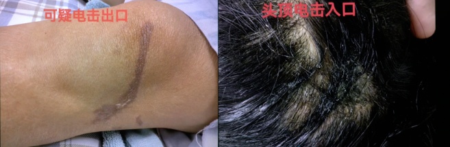 “我一点印象都没有”!一女子遭雷击后失忆…… “我一点印象都没有”!一女子遭雷击后失忆……