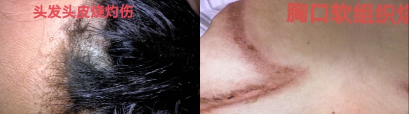 “我一点印象都没有”!一女子遭雷击后失忆…… “我一点印象都没有”!一女子遭雷击后失忆……