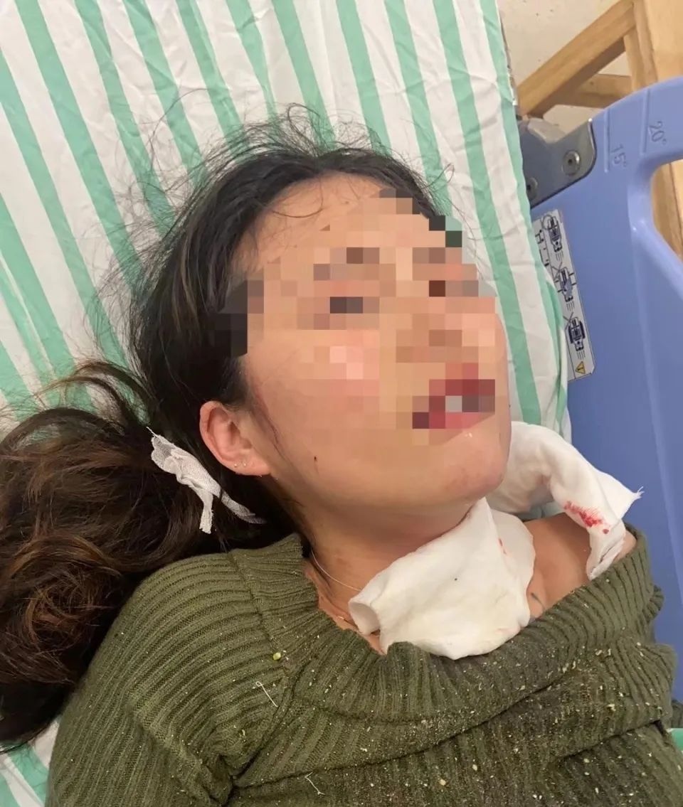 卡式炉突爆!女子严重炸伤,缝50针,左眼失明,左耳失聪 卡式炉突爆!女子严重炸伤,缝50针,左眼失明,左耳失聪