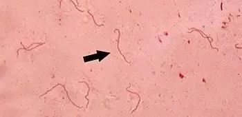 雨季当心！比得脚气危险的多，有人雨后趟水住进ICU