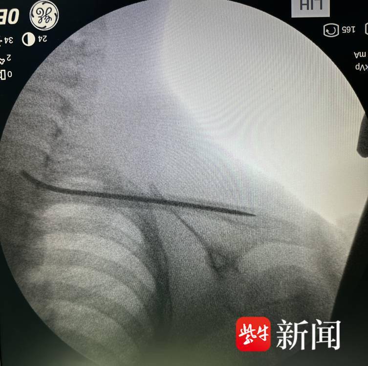 女童玩“转转椅”致锁骨骨折，医生不开刀“接骨”成功复位