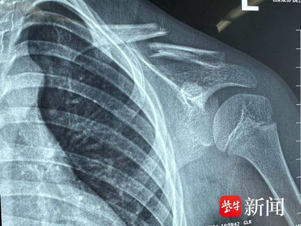 女童玩“转转椅”致锁骨骨折，医生不开刀“接骨”成功复位