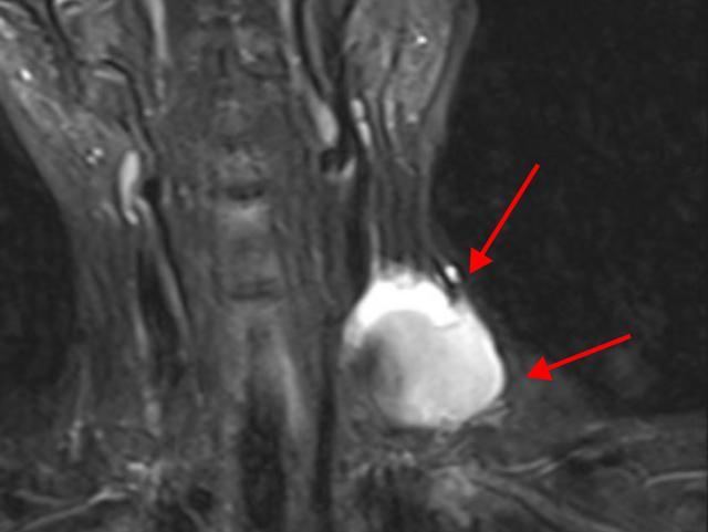 按摩后,这里竟长出苹果大小的“肿块”!医生提醒:这个部位很危险→ 按摩后,这里竟长出苹果大小的“肿块”!医生提醒:这个部位很危险→
