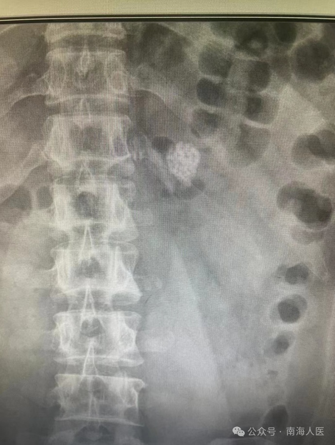 密密麻麻！30岁小伙腰部反复疼痛，体内竟取出100多粒结石