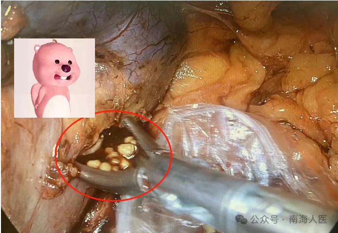 密密麻麻！30岁小伙腰部反复疼痛，体内竟取出100多粒结石