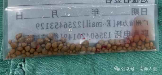 密密麻麻！30岁小伙腰部反复疼痛，体内竟取出100多粒结石