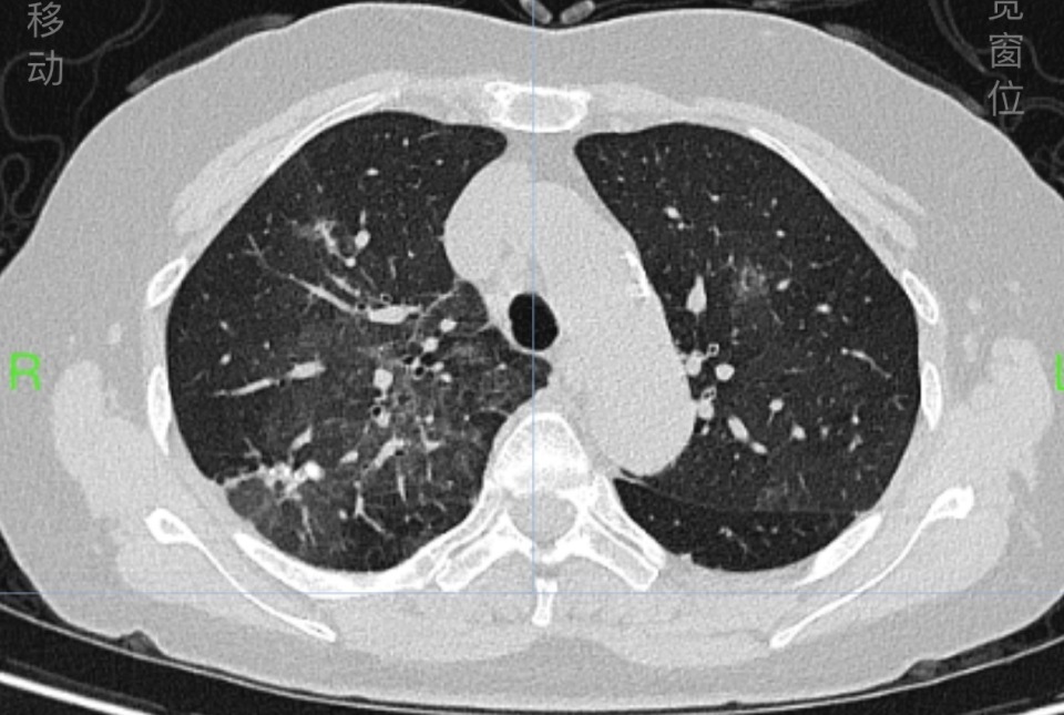 整理老照片后，长沙女子哮喘发作！专家提醒，过敏性哮喘患者注意这些
