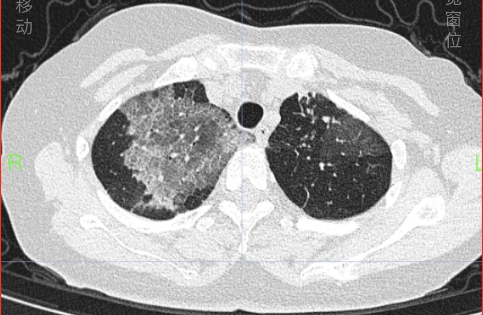 整理老照片后，长沙女子哮喘发作！专家提醒，过敏性哮喘患者注意这些