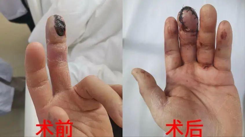 可能导致截指！长沙一男子吃完小龙虾，手指皮肤软组织坏死……