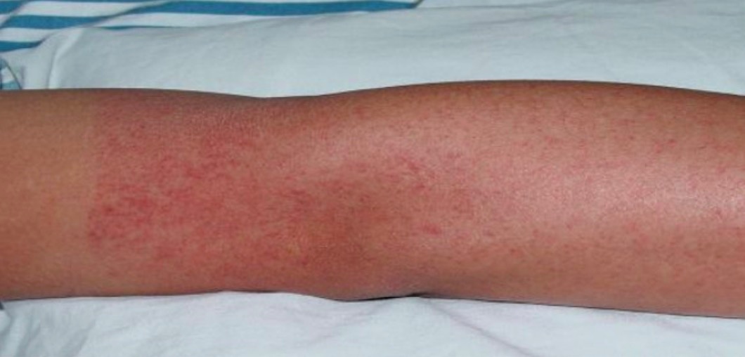 全球多地现登革热疫情，尚无特效药！重庆疾控提醒→