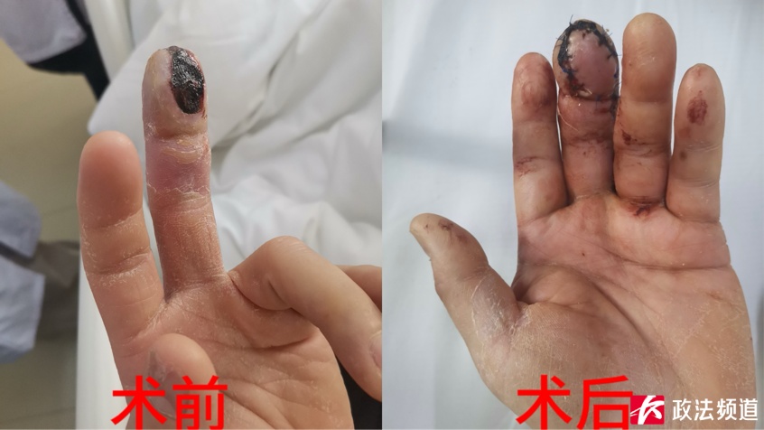 喜欢吃小龙虾的要注意，千万别被虾壳“背刺” 了！