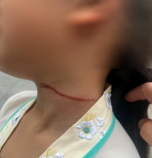 警惕!有人已被割伤脖子! 警惕!有人已被割伤脖子!