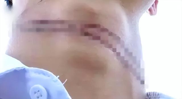 警惕!有人已被割伤脖子! 警惕!有人已被割伤脖子!