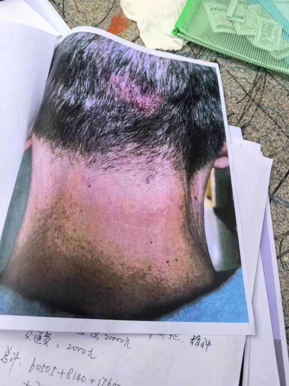 老人在小区被天降瓷砖砸伤致残,物业:赔偿金额分歧较大 老人在小区被天降瓷砖砸伤致残,物业:赔偿金额分歧较大