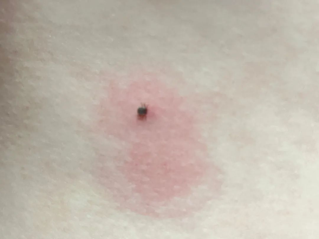 女子洗澡时,突然发现身上有“小黑点”!医生紧急提醒 女子洗澡时,突然发现身上有“小黑点”!医生紧急提醒