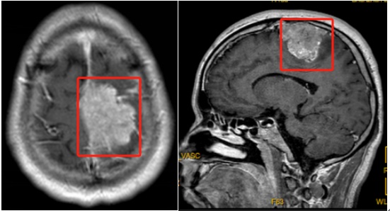 广东男子夹不住人字拖,竟查出脑内藏瘤!出现这些症状要留意 广东男子夹不住人字拖,竟查出脑内藏瘤!出现这些症状要留意