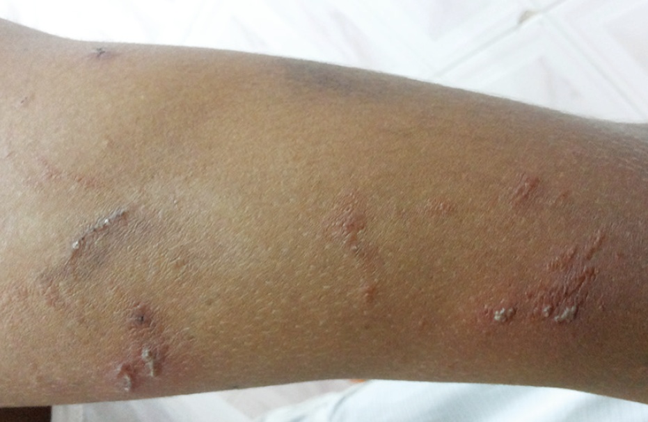 紧急提醒,即将进入活跃期!有人中招眼皮腐烂 有人脖子烂了一圈 紧急提醒,即将进入活跃期!有人中招眼皮腐烂 有人脖子烂了一圈