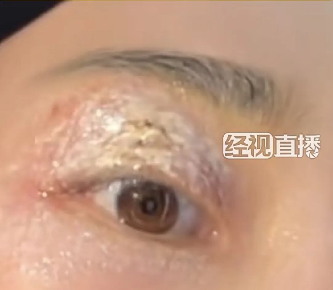 紧急提醒,即将进入活跃期!有人中招眼皮腐烂 有人脖子烂了一圈 紧急提醒,即将进入活跃期!有人中招眼皮腐烂 有人脖子烂了一圈