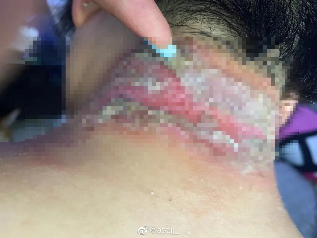 福州人注意!即将进入活跃期!有人中招脖子烂了一圈…… 福州人注意!即将进入活跃期!有人中招脖子烂了一圈……