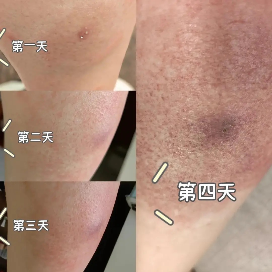 千万别碰,浙江已出现!紧急提醒:严重可致死,发现立即上报! 千万别碰,浙江已出现!紧急提醒:严重可致死,发现立即上报!