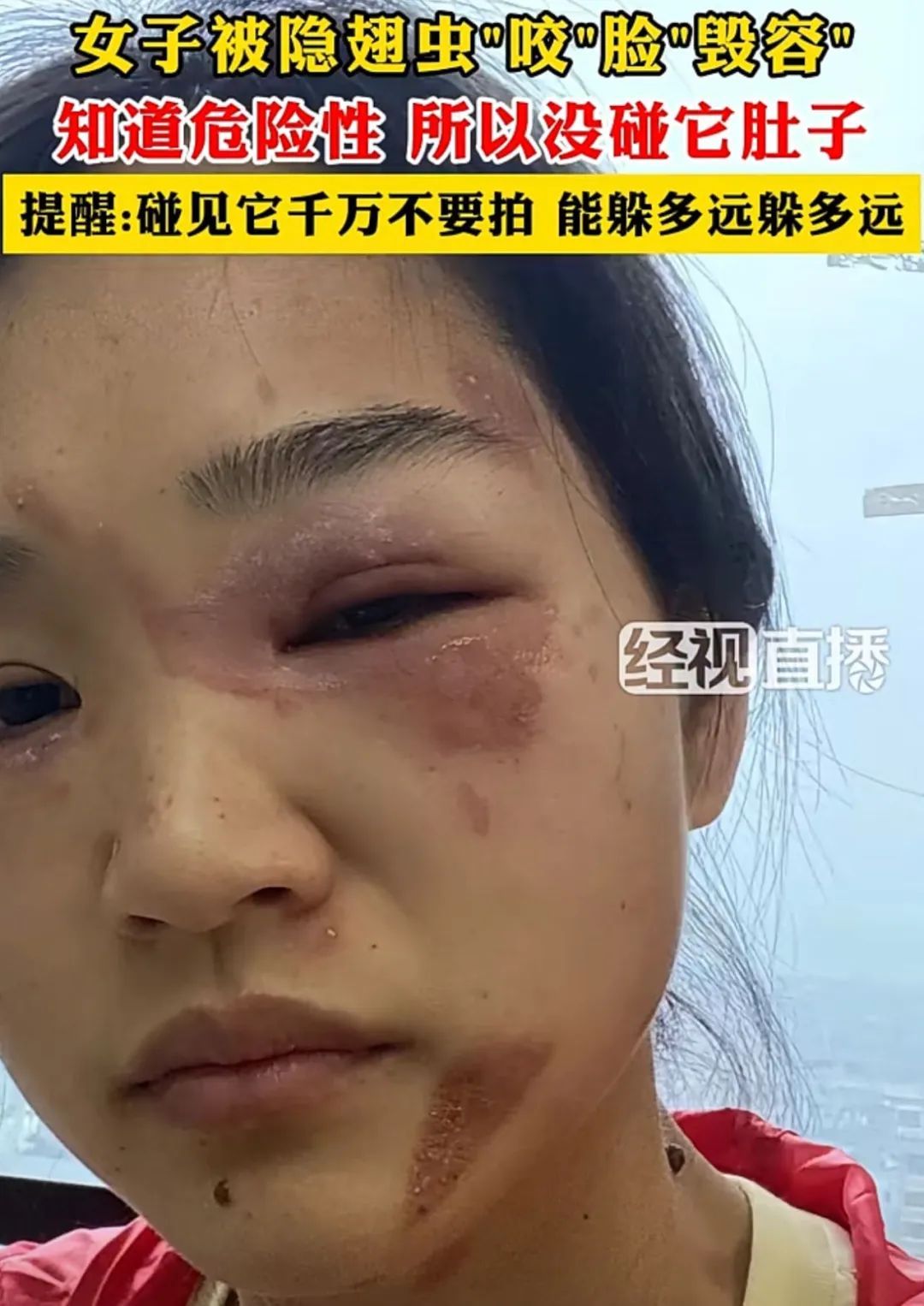 千万不能拍！“飞行的硫酸”即将进入活跃期，有人中招脖子烂了一圈