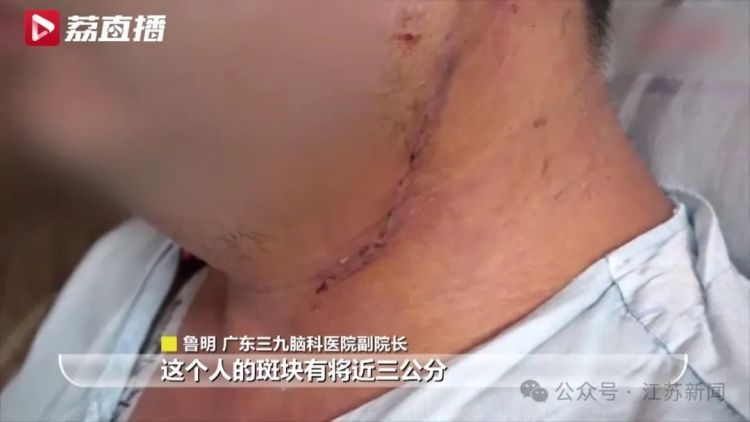男子半年内两次中风，颈动脉内竟剥出“脱壳虾”……警惕！