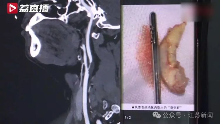 男子半年内两次中风，颈动脉内竟剥出“脱壳虾”……警惕！