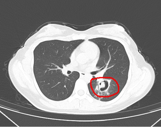 女孩高烧40℃，肺部“长满”霉斑！多人中招，这个细节要警惕