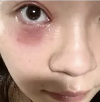 有人眼皮腐烂,有人却“元凶”都没见着!重要提醒:见到它不能用手…… 有人眼皮腐烂,有人却“元凶”都没见着!重要提醒:见到它不能用手……