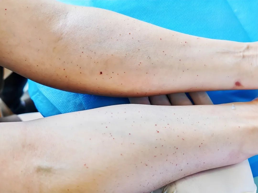 确诊了！女子手臂上都是小红点 密密麻麻……
