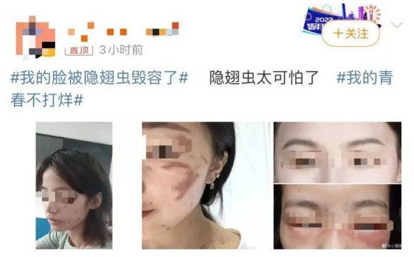 毒液堪比硫酸，已有人中招！这种虫夏天活跃，重庆高发