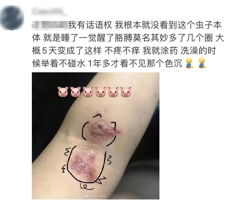 毒液堪比硫酸，已有人中招！这种虫夏天活跃，重庆高发