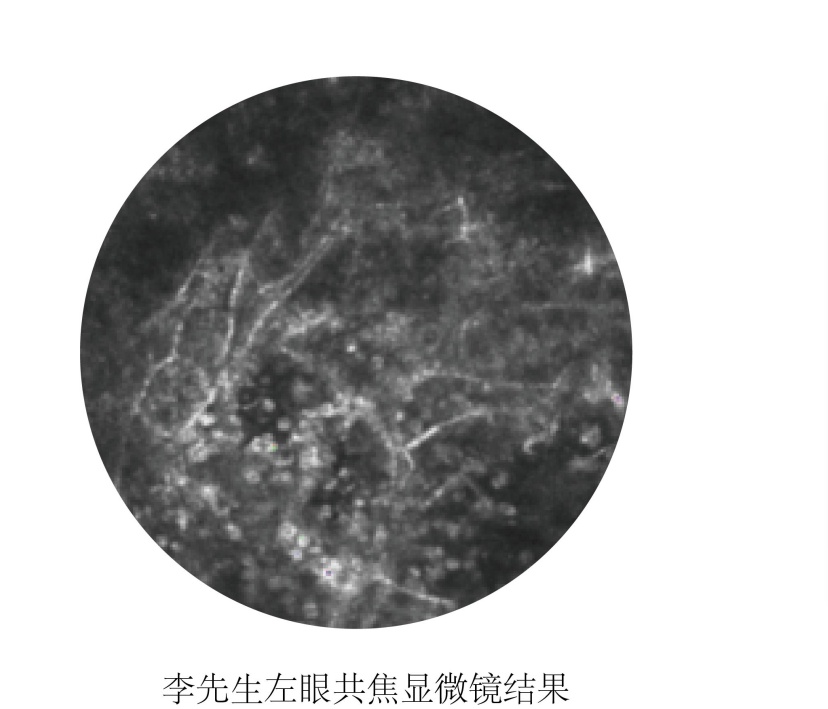 小心！男子左眼出现白色团块，竟是长霉了！