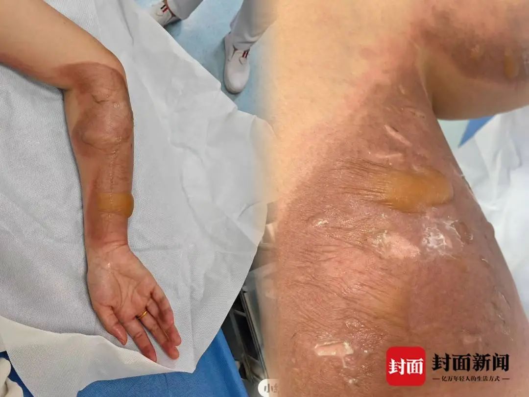 一女子称在酒店洗澡被烫伤，酒店：热水器最高温度为50℃