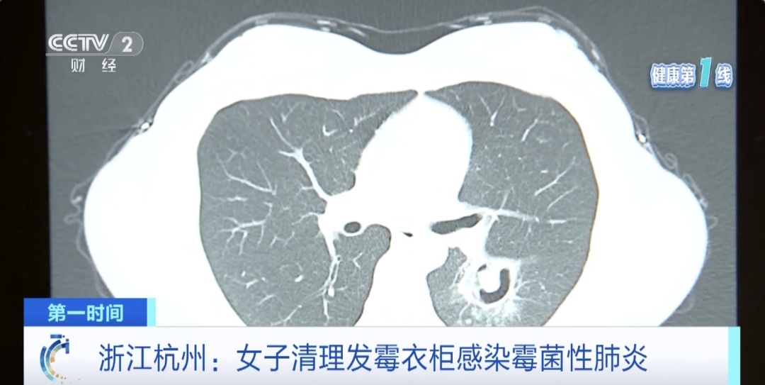 肺部“长满”霉菌！ 高烧不退！元凶竟是→