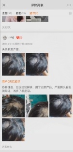 网购直发膏，美发不成反脱发！医生提醒→