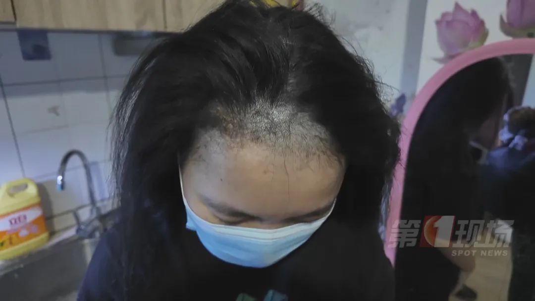 网购直发膏，美发不成反脱发！医生提醒→