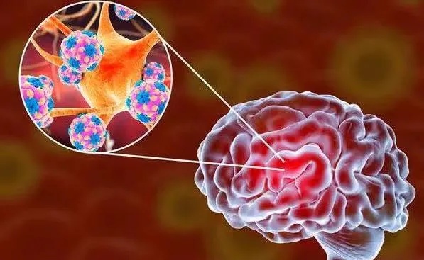 这种病近期冲上热搜！有人病发9天后死亡，初期症状像感冒，尚无特效药