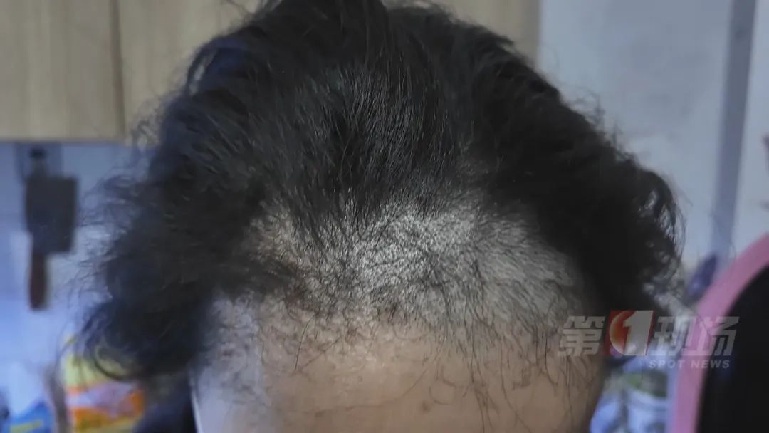 网购直发膏，美发不成反脱发！医生提醒→